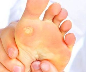 Prevención y tratamiento del papiloma en deportistas